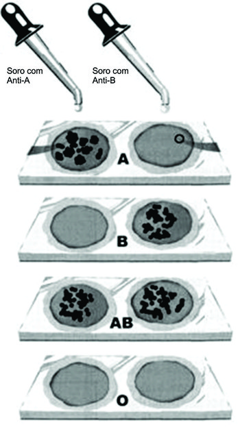 Figura 1:Pode ser observado aglutinação nos grupo A e AB ao adicionar o soro anti-A e aglutinação do grupo B e AB no soro anti-B (Foto: Reprodução/Colégio Qi)